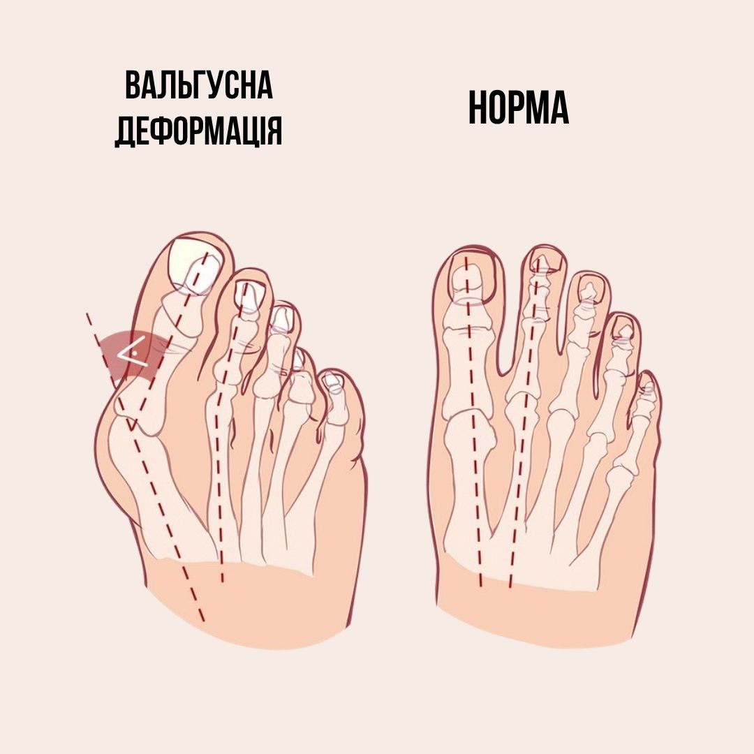 як виглядає вальгусна деформація стопи