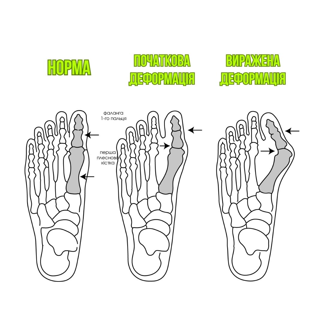 Як прибрати вальгус