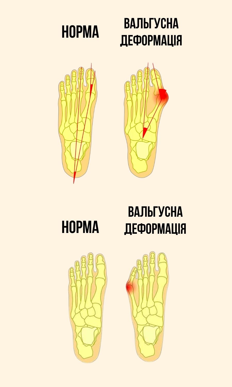 Що буде, якщо не лікувати вальгус