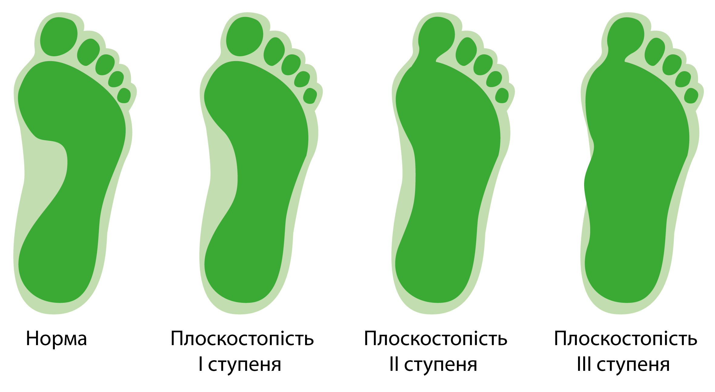 Как выглядит плоскостопие у детей