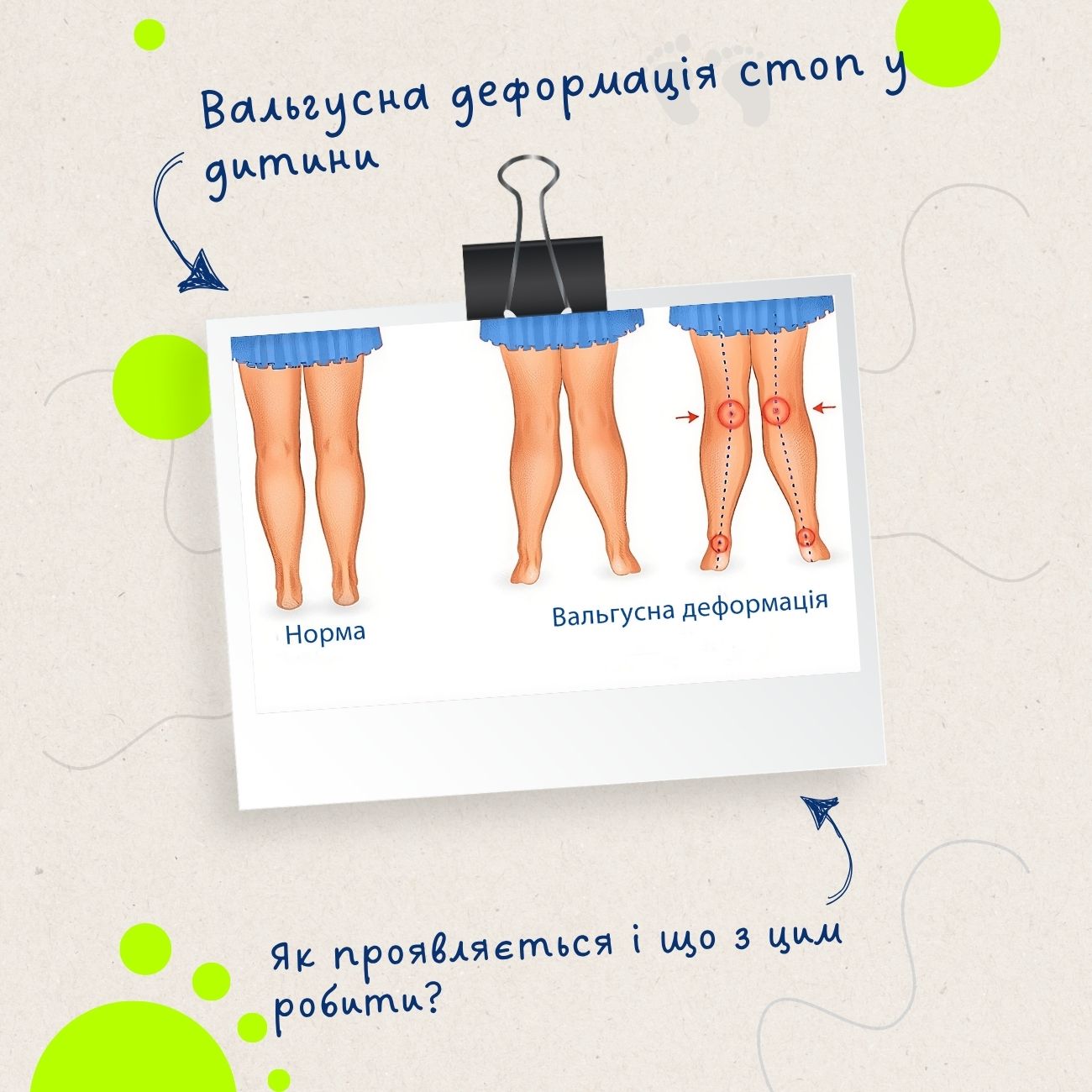 вальгусна деформація стоп у дітей