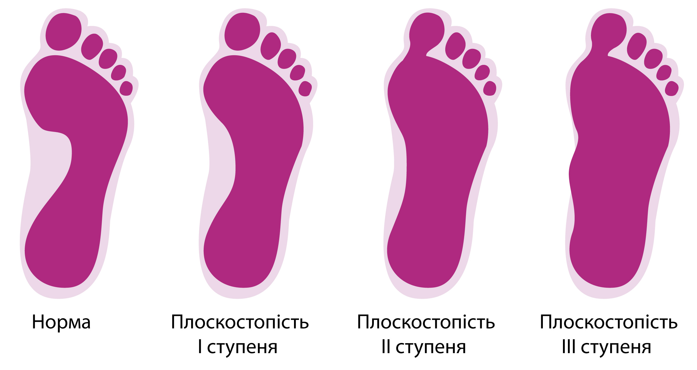 як визначити плоскостопість у дитини