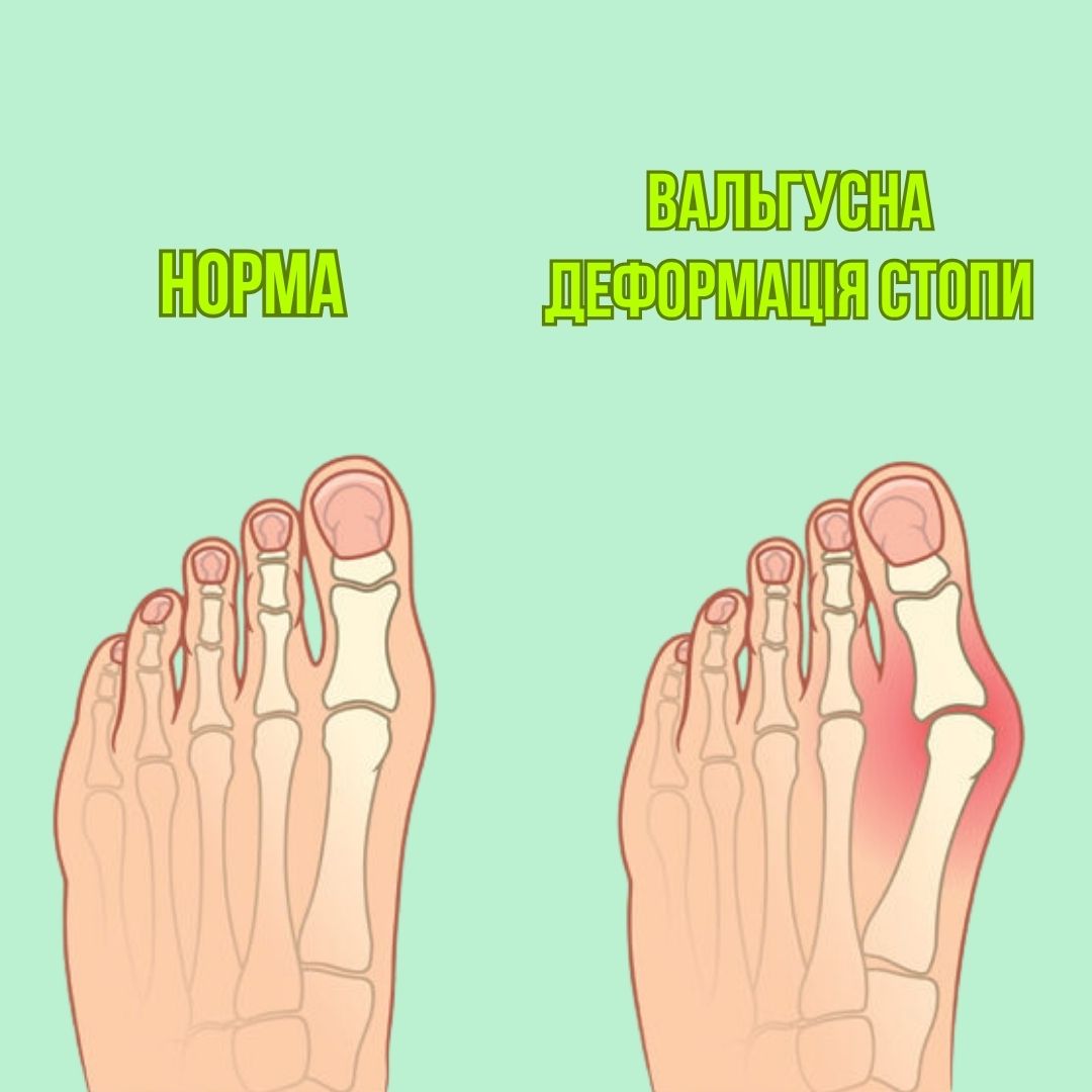 Вальгусна деформація: ранні симптоми, причини та способи уповільнити розвиток