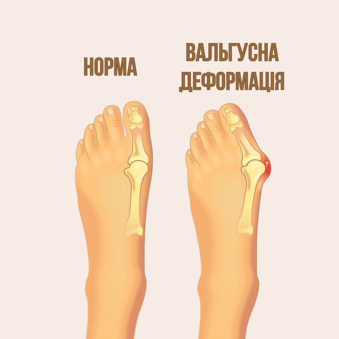 Що провокує вальгусну деформацію стопи
