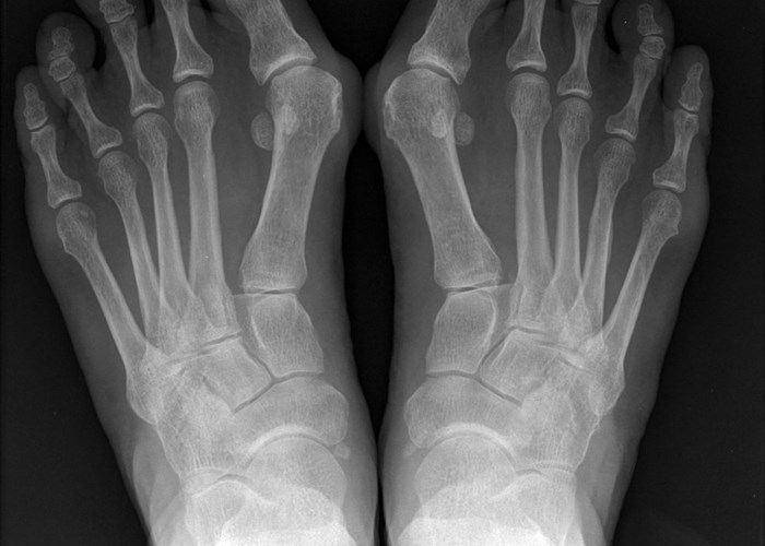 Чим небезпечний вальгус