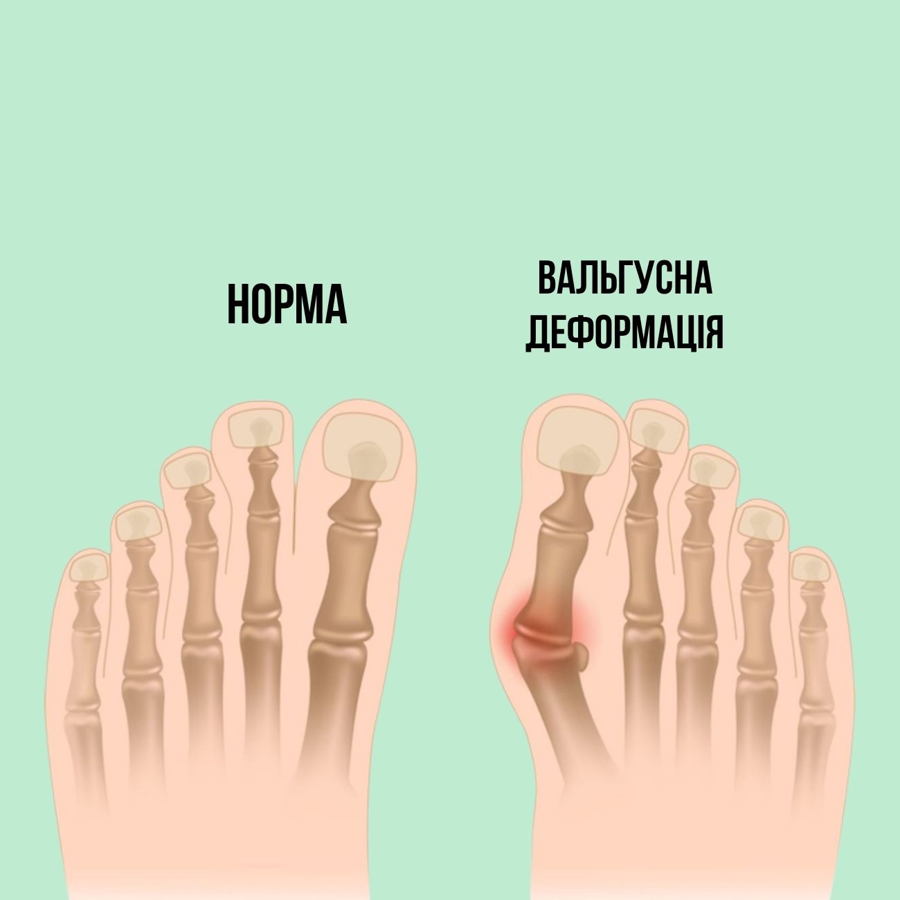 Як уникнути вальгусу