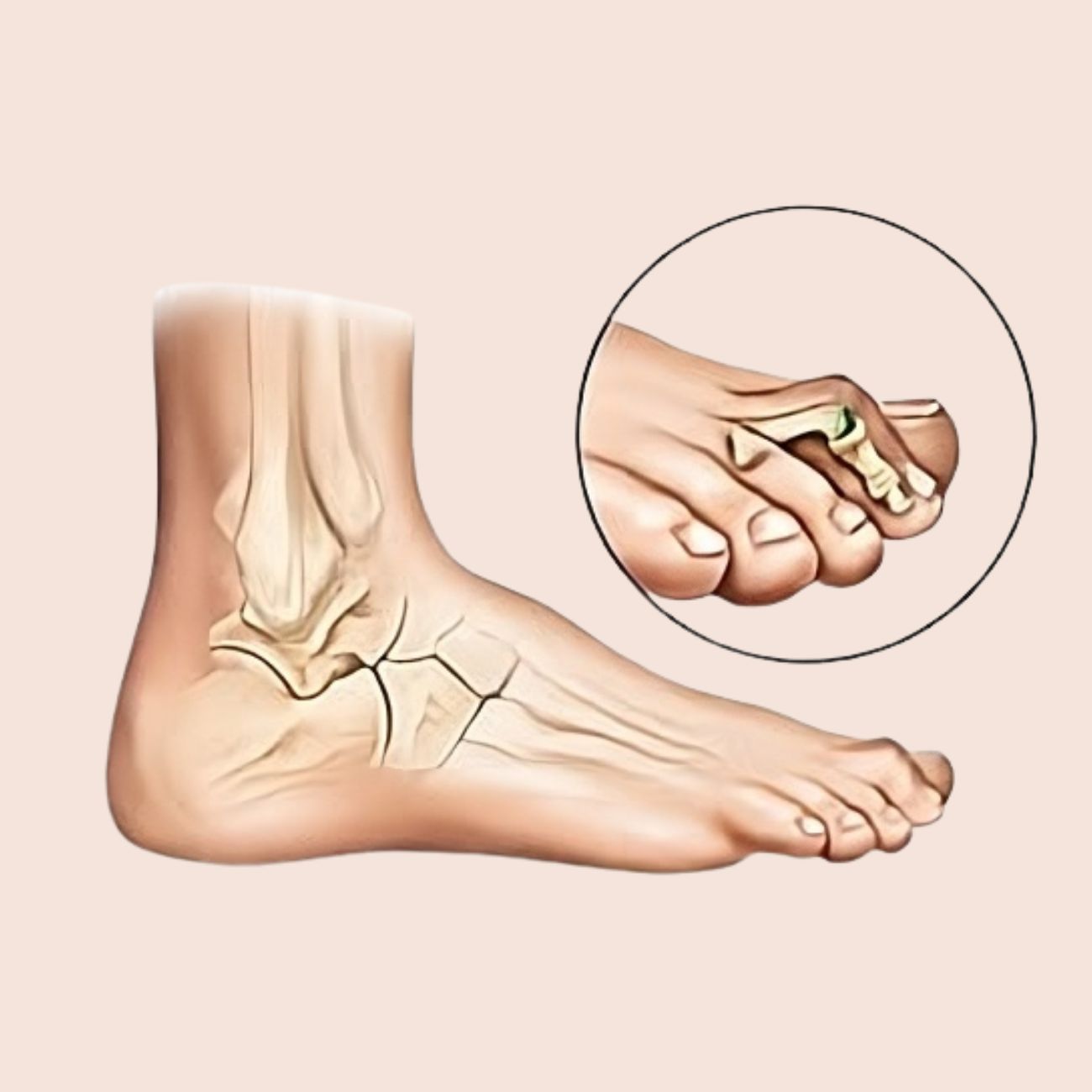 Молоткоподібні пальці ніг: причини, корекція та сучасні підходи до лікування
