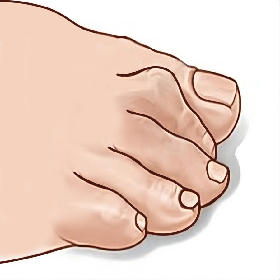 Кігтеподібні пальці ніг, причини, лікування